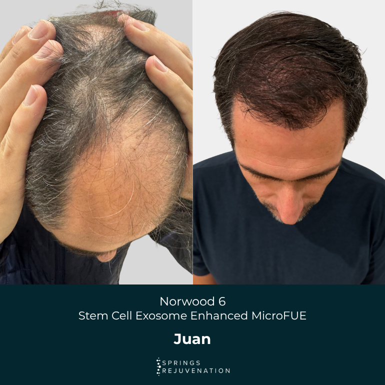 Juan - Before & After